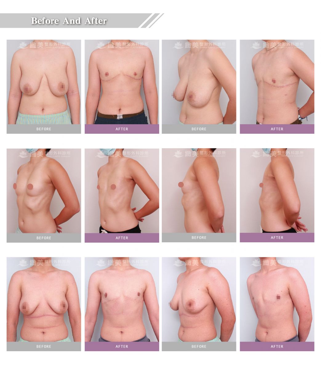 Breast extraction online